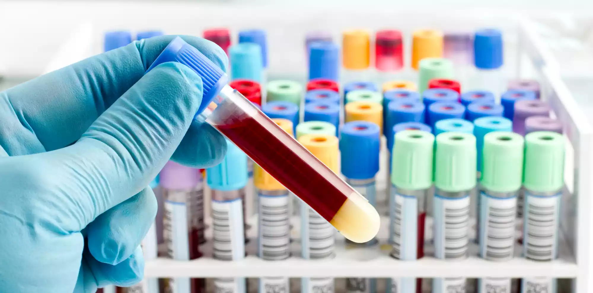 Blood-Based Sensor Detects Parkinson’s-Linked Proteins in 40 Minutes